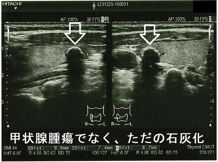 甲状腺腫瘍でなくただの石灰化 甲状腺腫瘍でなくただの石灰化