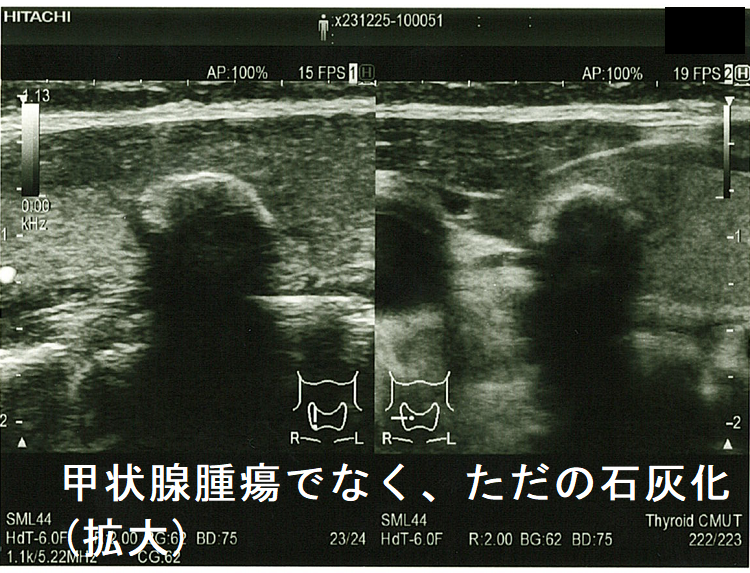 甲状腺の病気にCT、MRIは有用でない[橋本病 バセドウ病 甲状腺