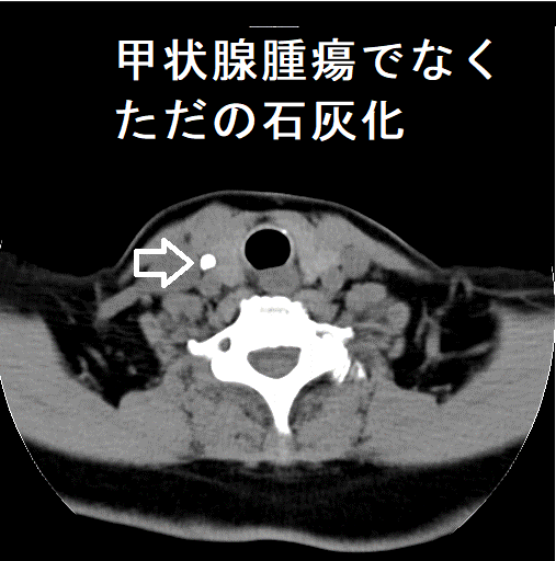 甲状腺腫瘍でなく、ただの石灰化 単純CT画像 甲状腺腫瘍でなく、ただの石灰化 単純CT画像