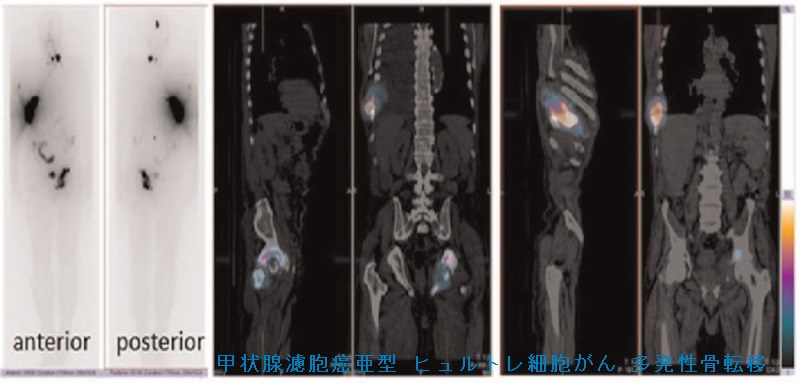 甲状腺濾胞がん亜型 ヒュルトレ細胞甲状腺がん 多発性骨転移 甲状腺濾胞がん亜型 ヒュルトレ細胞甲状腺がん 多発性骨転移