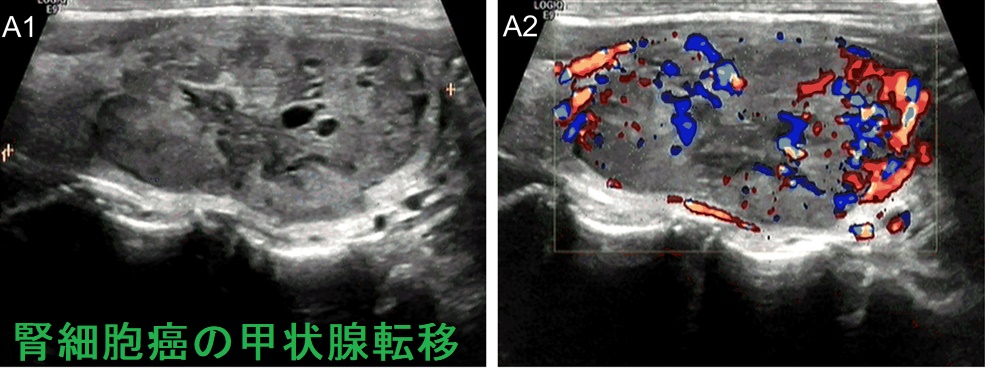 腎細胞癌の甲状腺転移 腎細胞癌の甲状腺転移