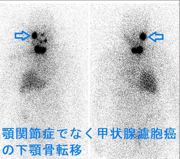 顎関節症でなく甲状腺濾胞がんの下顎骨転移 I-131 シンチグラフィー 顎関節症でなく甲状腺濾胞がんの下顎骨転移 I-131 シンチグラフィー