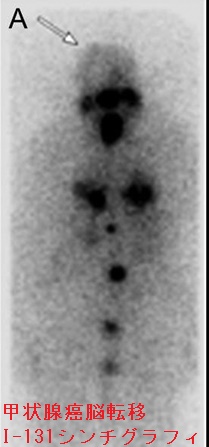 甲状腺癌脳転移 I-131 シンチグラフィ 甲状腺癌脳転移 I-131 シンチグラフィ