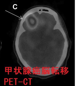 甲状腺癌脳転移 PET-CT 甲状腺癌脳転移 PET-CT