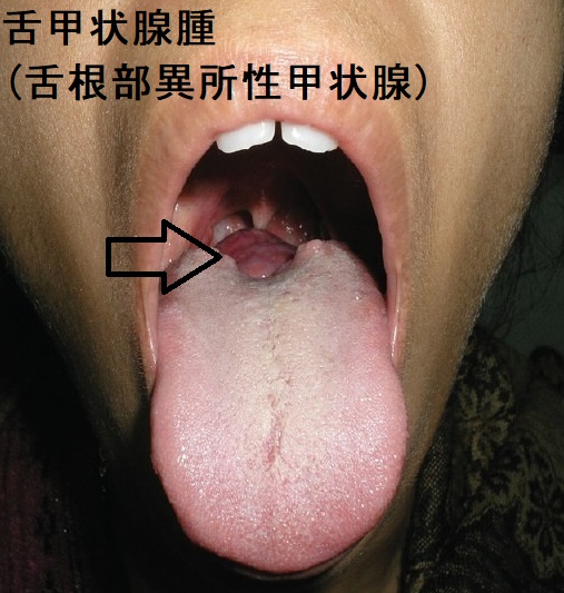 舌甲状腺腫(舌根部異所性甲状腺、舌根部甲状腺)2 舌甲状腺腫(舌根部異所性甲状腺、舌根部甲状腺)2