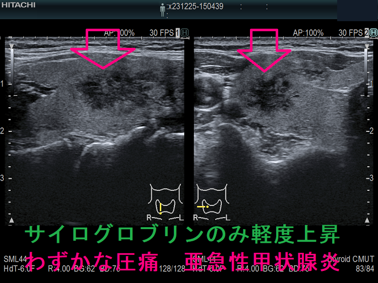 サイログロブリンのみ軽度上昇 わずかな圧痛 亜急性甲状腺炎 サイログロブリンのみ軽度上昇 わずかな圧痛 亜急性甲状腺炎