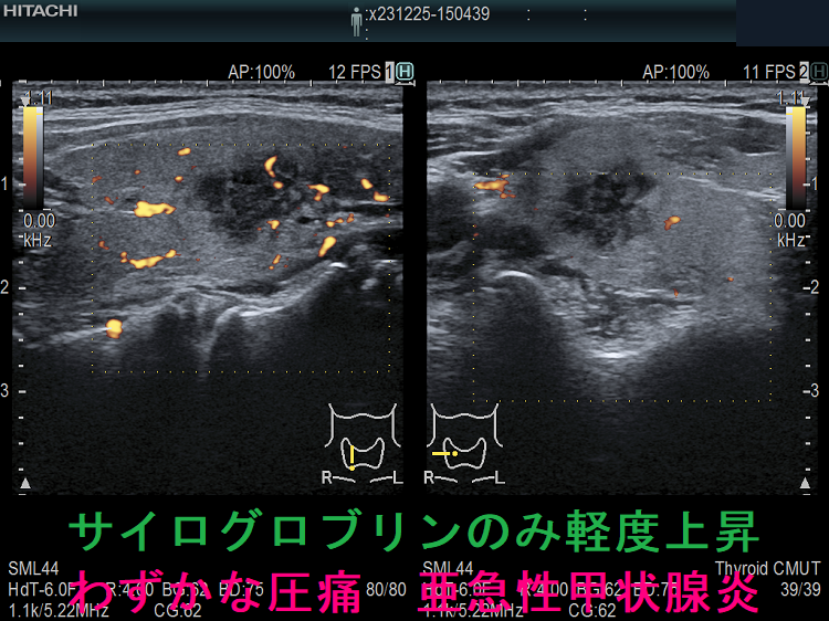 サイログロブリンのみ軽度上昇 わずかな圧痛 亜急性甲状腺炎 ドプラーモード サイログロブリンのみ軽度上昇 わずかな圧痛 亜急性甲状腺炎 ドプラーモード