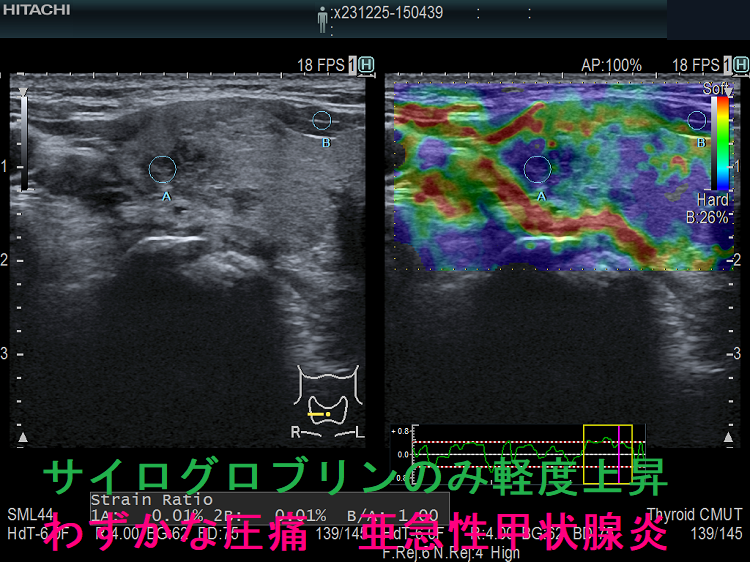 サイログロブリンのみ軽度上昇 わずかな圧痛 亜急性甲状腺炎 エラストグラフィー サイログロブリンのみ軽度上昇 わずかな圧痛 亜急性甲状腺炎 エラストグラフィー