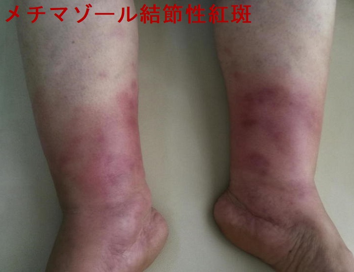メチマゾール結節性紅斑 メチマゾール結節性紅斑