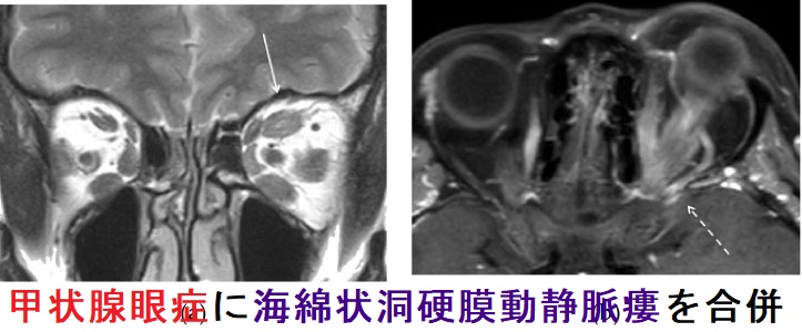 甲状腺眼症に海綿状洞硬膜動静脈瘻を合併 甲状腺眼症に海綿状洞硬膜動静脈瘻を合併