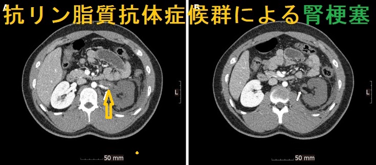 抗リン脂質抗体症候群による腎梗塞 抗リン脂質抗体症候群による腎梗塞