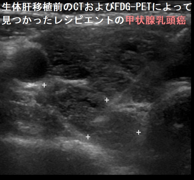 生体肝移植前のCTおよびFDG-PETによって見つかったレシピエントの甲状腺乳頭癌 超音波(エコー)画像 生体肝移植前のCTおよびFDG-PETによって見つかったレシピエントの甲状腺乳頭癌 超音波(エコー)画像