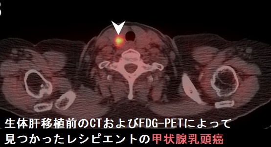 生体肝移植前のCTおよびFDG-PETによって見つかったレシピエントの甲状腺乳頭癌 生体肝移植前のCTおよびFDG-PETによって見つかったレシピエントの甲状腺乳頭癌