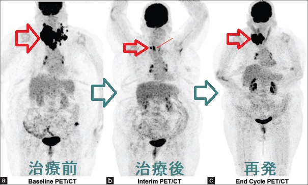 甲状腺悪性リンパ腫 PET-FDG/CT 甲状腺悪性リンパ腫 PET-FDG/CT