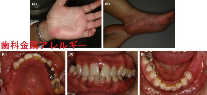 歯科金属アレルギー 歯科金属アレルギー