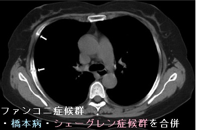 ファンコニ症候群・甲状腺機能低下症 橋本病・シェーグレン症候群を合併 ファンコニ症候群・甲状腺機能低下症 橋本病・シェーグレン症候群を合併