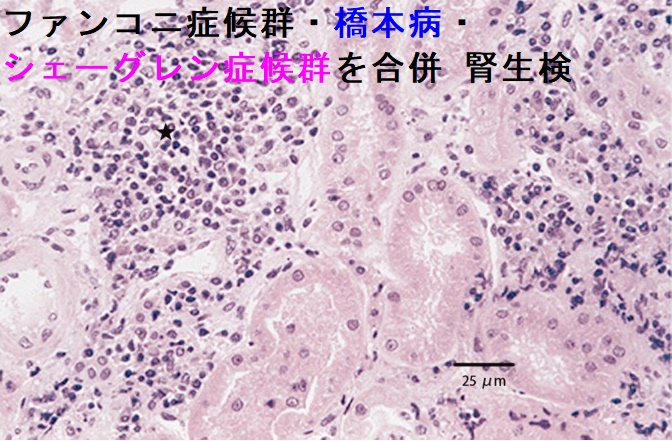 ファンコニ症候群・甲状腺機能低下症 橋本病・シェーグレン症候群を合併 腎生検 ファンコニ症候群・甲状腺機能低下症 橋本病・シェーグレン症候群を合併 腎生検