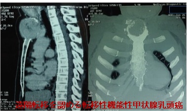 遠隔転移を認める転移性機能性甲状腺乳頭癌 遠隔転移を認める転移性機能性甲状腺乳頭癌