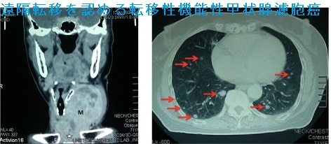 遠隔転移を認める転移性機能性甲状腺濾胞癌 遠隔転移を認める転移性機能性甲状腺濾胞癌