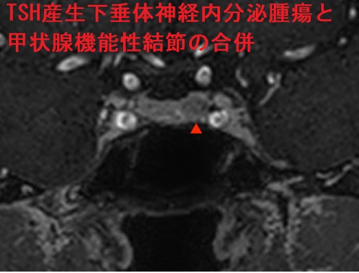 TSH産生下垂体神経内分泌腫瘍と甲状腺機能性結節の合併 下垂体MRI TSH産生下垂体神経内分泌腫瘍と甲状腺機能性結節の合併 下垂体MRI