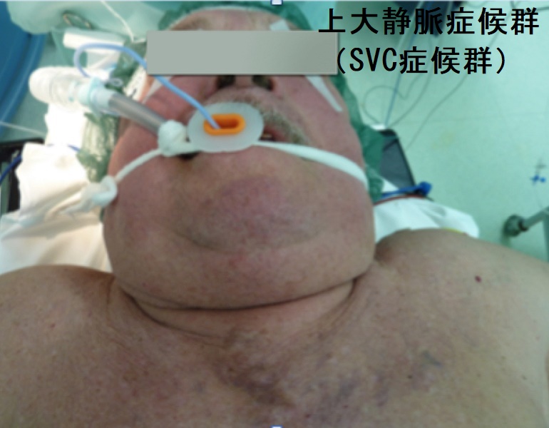 上大静脈症候群(SVC症候群) 上大静脈症候群(SVC症候群)