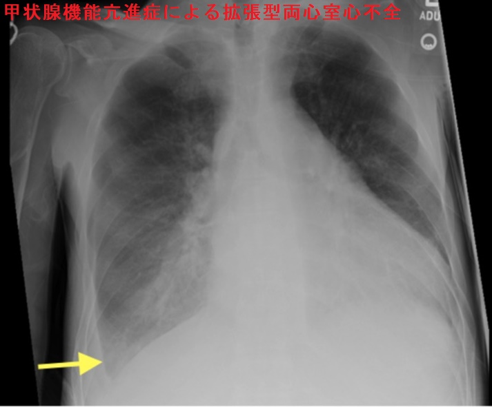 甲状腺機能亢進症/バセドウ病による拡張型両心室心不全 胸部X線 甲状腺機能亢進症/バセドウ病による拡張型両心室心不全 胸部X線