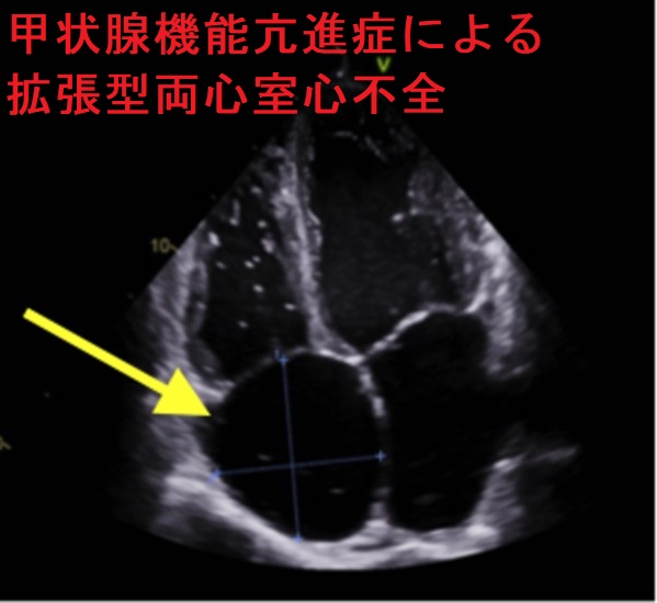 甲状腺機能亢進症/バセドウ病による拡張型両心室心不全 心エコー 甲状腺機能亢進症/バセドウ病による拡張型両心室心不全 心エコー