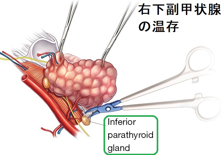 末期腎不全・透析・腎移植と甲状腺[橋本病 バセドウ病 エコー検査