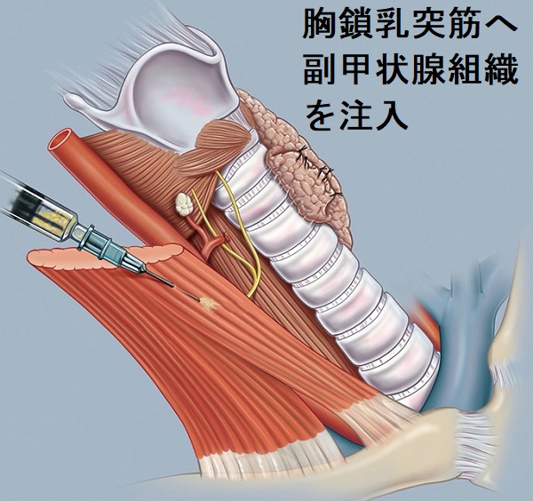 末期腎不全・透析・腎移植と甲状腺[橋本病 バセドウ病 エコー検査