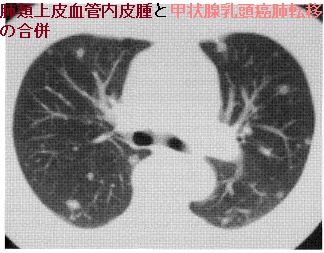 肺類上皮血管内皮腫(EHE)と甲状腺乳頭癌肺転移を合併 肺類上皮血管内皮腫(EHE)と甲状腺乳頭癌肺転移を合併