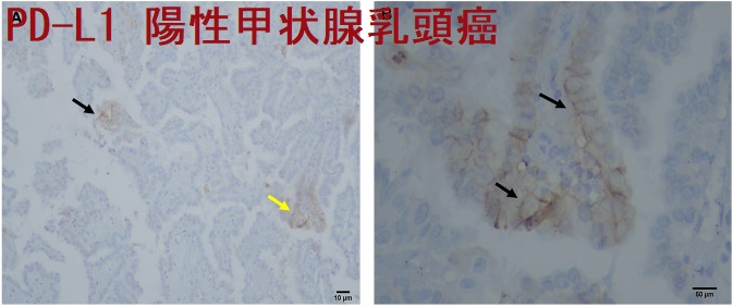 PD-L1 陽性甲状腺乳頭癌 PD-L1 陽性甲状腺乳頭癌