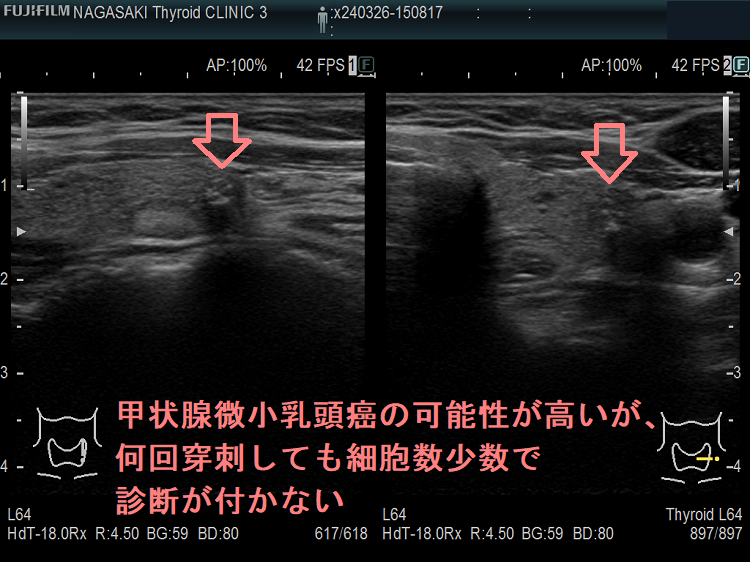 甲状腺微小乳頭癌の可能性が高いが、 何回穿刺しても細胞数少数で診断が付かない 甲状腺微小乳頭癌の可能性が高いが、 何回穿刺しても細胞数少数で診断が付かない