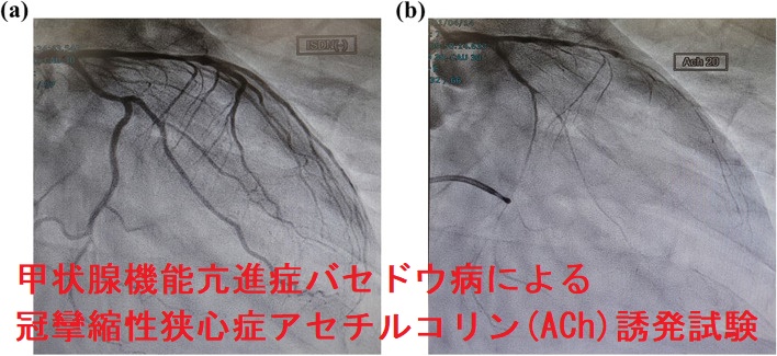 甲状腺機能亢進症バセドウ病による冠攣縮性狭心症 アセチルコリン(ACh)誘発試験 甲状腺機能亢進症バセドウ病による冠攣縮性狭心症 アセチルコリン(ACh)誘発試験