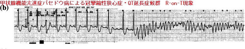 甲状腺機能亢進症バセドウ病による冠攣縮性狭心症・QT延長症候群 R-on-T現象 甲状腺機能亢進症バセドウ病による冠攣縮性狭心症・QT延長症候群 R-on-T現象