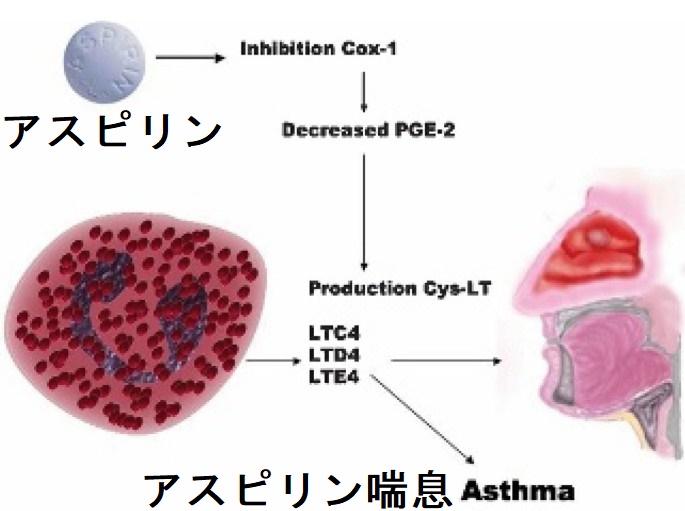 アスピリン喘息 アスピリン喘息