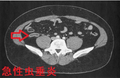急性虫垂炎 造影CT 横断像 急性虫垂炎 造影CT 横断像