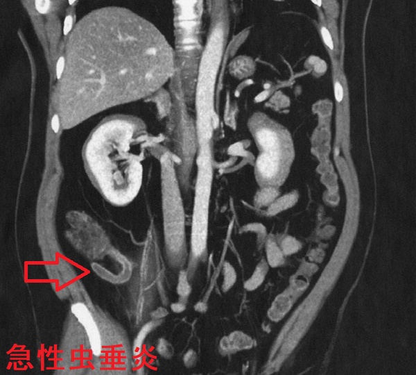 急性虫垂炎 造影CT 斜冠状断像 急性虫垂炎 造影CT 斜冠状断像