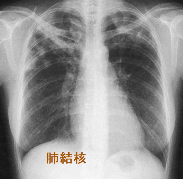 活動性肺結核 胸部エックス線写真 活動性肺結核 胸部エックス線写真