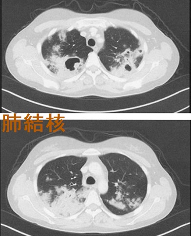 活動性肺結核 胸部造影CT画像 活動性肺結核 胸部造影CT画像