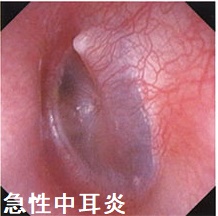 急性中耳炎 急性中耳炎