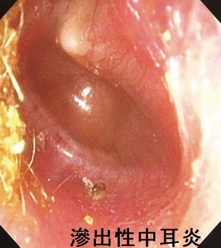 滲出性中耳炎 滲出性中耳炎