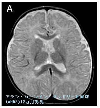 アラン・ハーンドン・ダッドリー症候群(AHDS)12カ月男児のMRI T2強調画像 アラン・ハーンドン・ダッドリー症候群(AHDS)12カ月男児のMRI T2強調画像