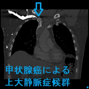 107D28 | 縦隔腫瘍 国試 | テコプラ