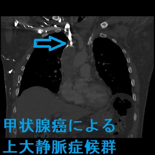縦隔内甲状腺腫[橋本病 バセドウ病 甲状腺超音波検査エコー