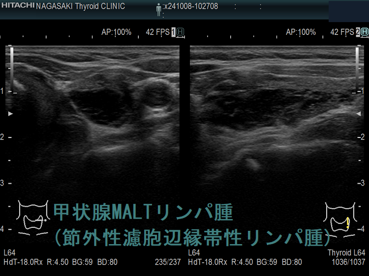 甲状腺MALTリンパ腫(節外性濾胞辺縁帯性リンパ腫) 甲状腺MALTリンパ腫(節外性濾胞辺縁帯性リンパ腫)