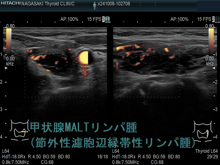 甲状腺MALTリンパ腫(節外性濾胞辺縁帯性リンパ腫)ドプラーモード 甲状腺MALTリンパ腫(節外性濾胞辺縁帯性リンパ腫)ドプラーモード