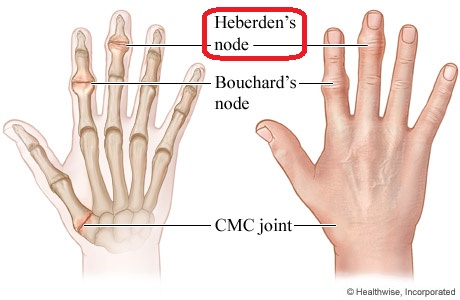甲状腺とヘバーデン結節 甲状腺とヘバーデン結節
