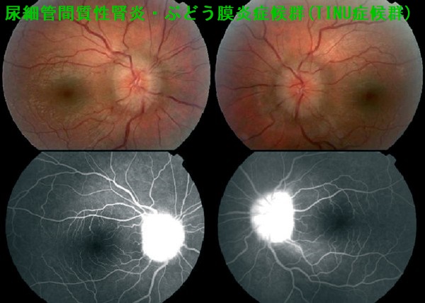 尿細管間質性腎炎・ぶどう膜炎症候群(TINU症候群) 尿細管間質性腎炎・ぶどう膜炎症候群(TINU症候群)