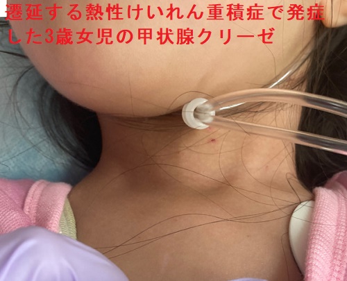 遷延する熱性けいれん重積症で発症した3歳女児の甲状腺クリーゼ 遷延する熱性けいれん重積症で発症した3歳女児の甲状腺クリーゼ