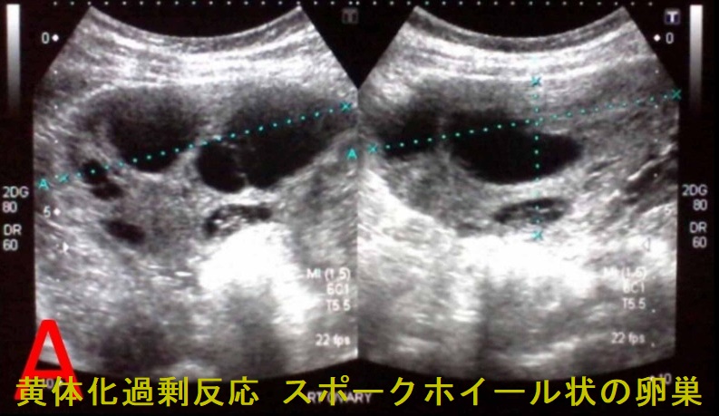 黄体化過剰反応 スポークホイール状の卵巣 黄体化過剰反応 スポークホイール状の卵巣